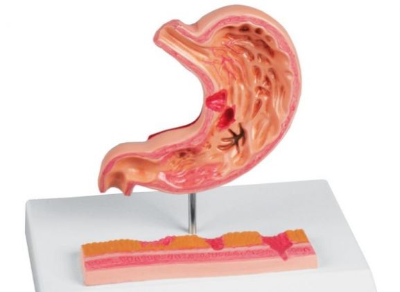 https://mail.jayakelana.id/uploads/product/-k217-stomach-with-ulcers-69392f48960fe9e_cover.jpg