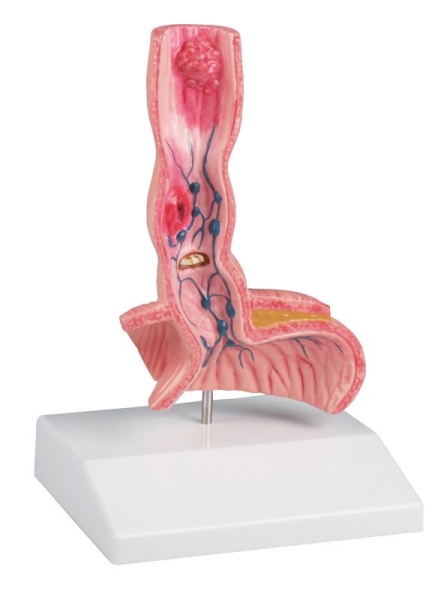 (K218) Oesophagus Diseases