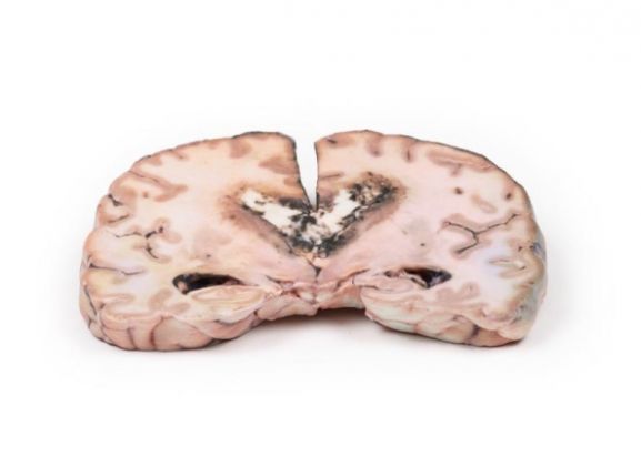 https://mail.jayakelana.id/uploads/product/-mp2003-glioma-grade-3-4--15959f8d55a3304_cover.jpg