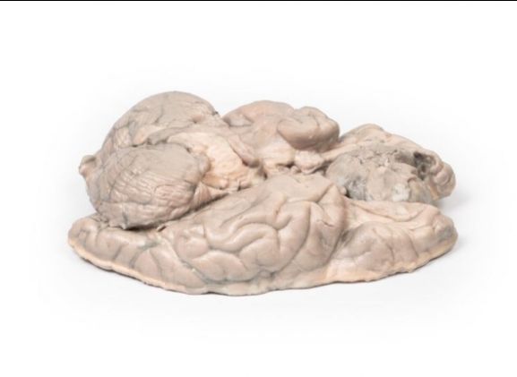 https://mail.jayakelana.id/uploads/product/-mp2004-meningioma-6961502fd874c81_cover.jpg