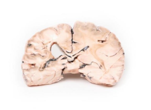 https://mail.jayakelana.id/uploads/product/-mp2005-left-cerebral-infarct-79391d7c5ffe427_cover.jpg