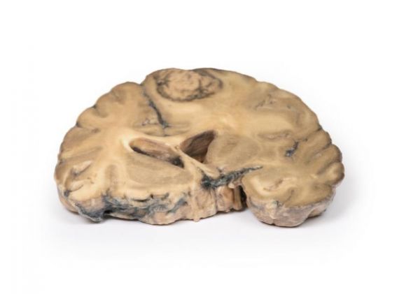 https://mail.jayakelana.id/uploads/product/-mp2007-metastatic-adenocarcinoma-in-681531e669e5ea8_cover.jpg